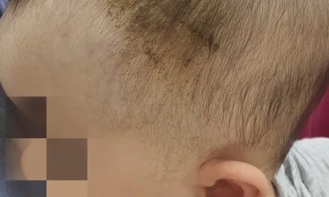 Bé 7 tuổi chấn thương nặng sau cú ngã tưởng vô hại
