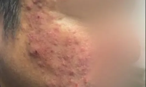 Tưởng mụn trứng cá, người đàn ông đi khám phát hiện "thủ phạm thầm lặng" gây bệnh