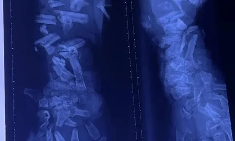 Tai nạn lao động thương tâm: Công nhân 37 tuổi bị máy nghiền vỏ dừa cán nát cánh tay