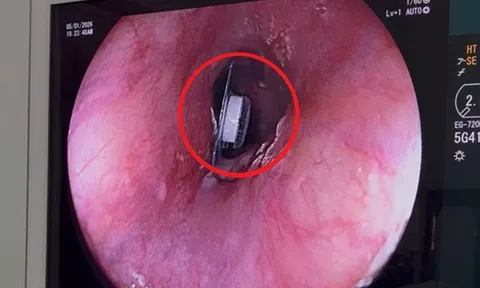 Người phụ nữ 60 tuổi đau ngực thốc ngược lên, bác sĩ phát hiện bí mật "đáng sợ" bên trong