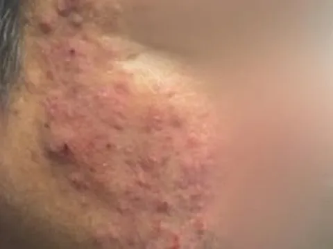 Tưởng mụn trứng cá, người đàn ông đi khám phát hiện "thủ phạm thầm lặng" gây bệnh