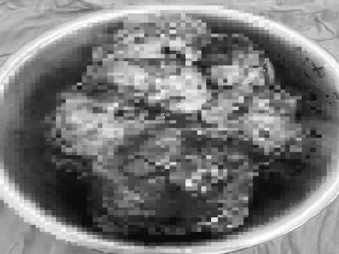 Cắt bỏ khối u dạ dày “khủng” nặng 3,7kg cho bệnh nhân nữ từng sợ …mổ