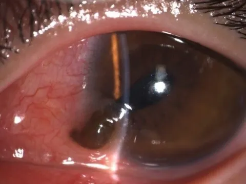 Khẩn cứu người đàn ông bị đinh bắn vào mắt