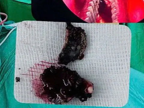 Chảy nước mũi hôi nhiều năm, bệnh nhân 23 tuổi đi khám bác sĩ gắp ra thứ "đáng sợ"