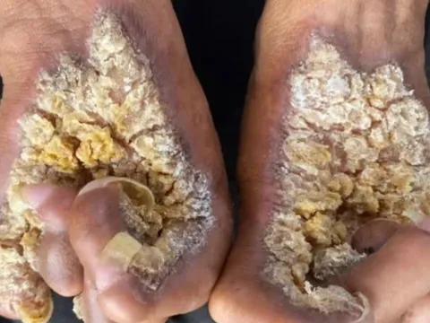 Người đàn ông thứ hai tại Việt Nam mắc hội chứng “người cây”