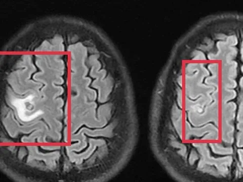 Người đàn ông 39 tuổi đau đầu, bác sĩ phát hiện thứ "đáng sợ" bên trong
